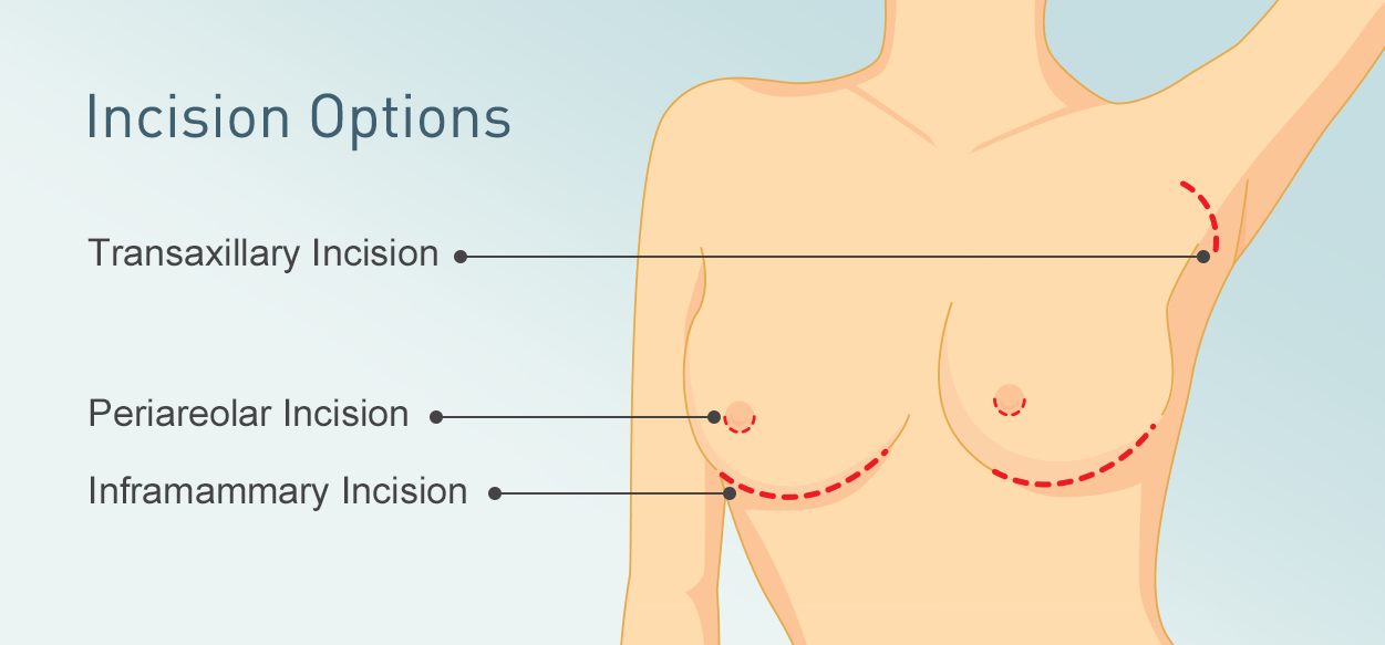 Incision Options
