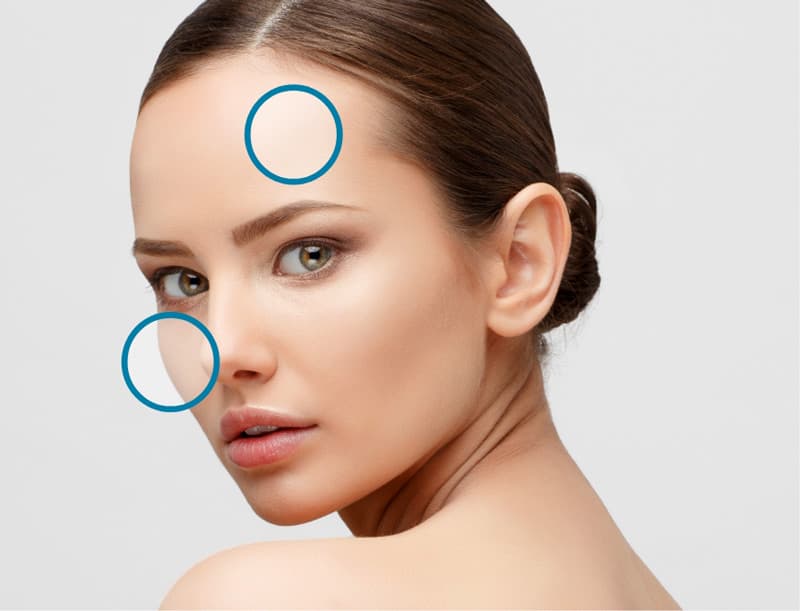 Treatment planner model showing acne & acne scarring area