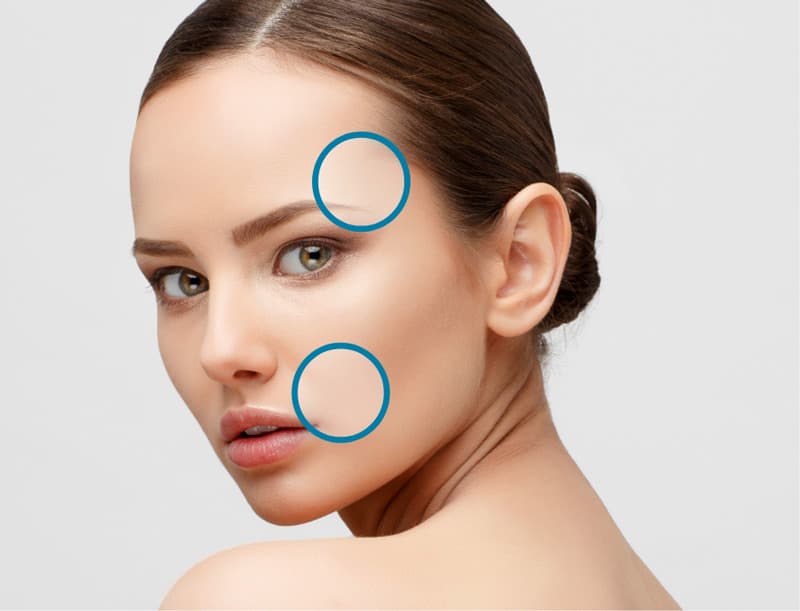 Treatment planner model showing frown lines, crow's feet, & forehead lines area