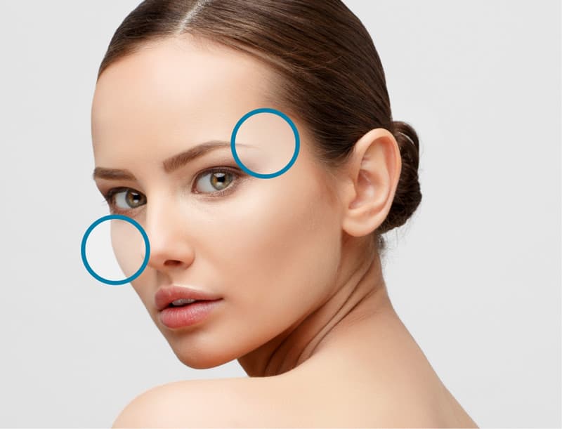 Treatment planner model showing lax, thinning skin area