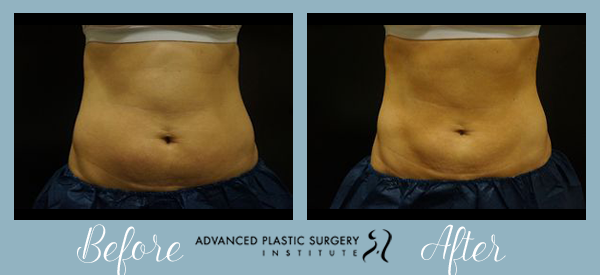 Before and After CoolSculpting at Advanced Plastic Surgery Institute.