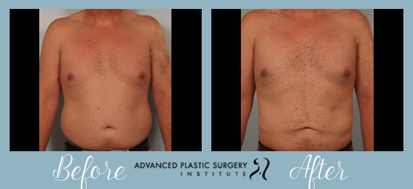 Before and After Liposuction at Advanced Plastic Surgery Institute.
