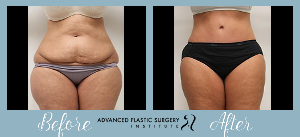 Before and After Tummy Tuck at Advanced Plastic Surgery Institute.