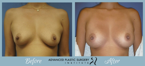 Before and After Breast Augmentation with Dr. Josh Olson