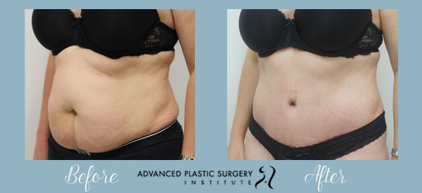 Can You Have A Baby After A Tummy Tuck?