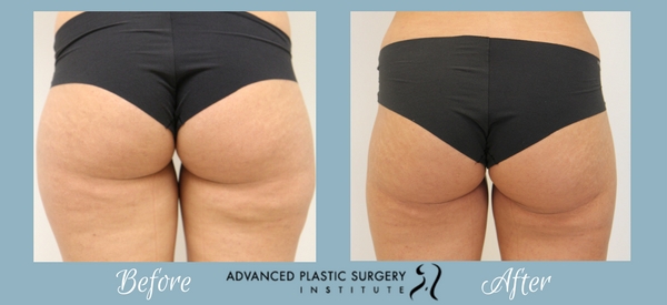 Before and After Liposuction by Dr. Josh Olson