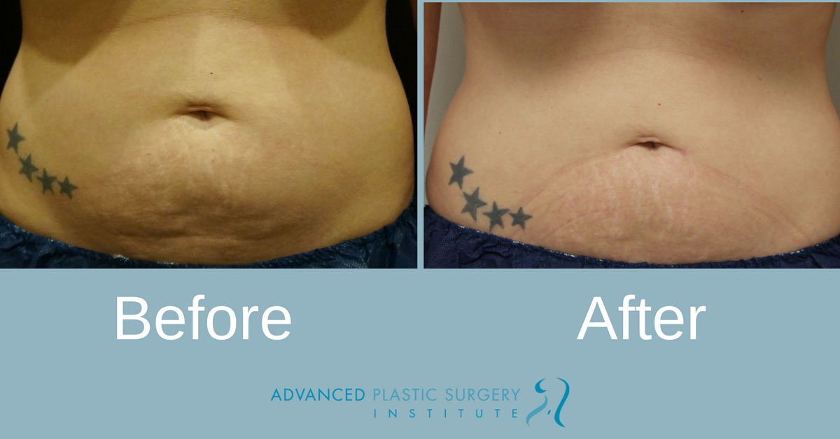 Real Coolsculpting Patient Before and After Treatment