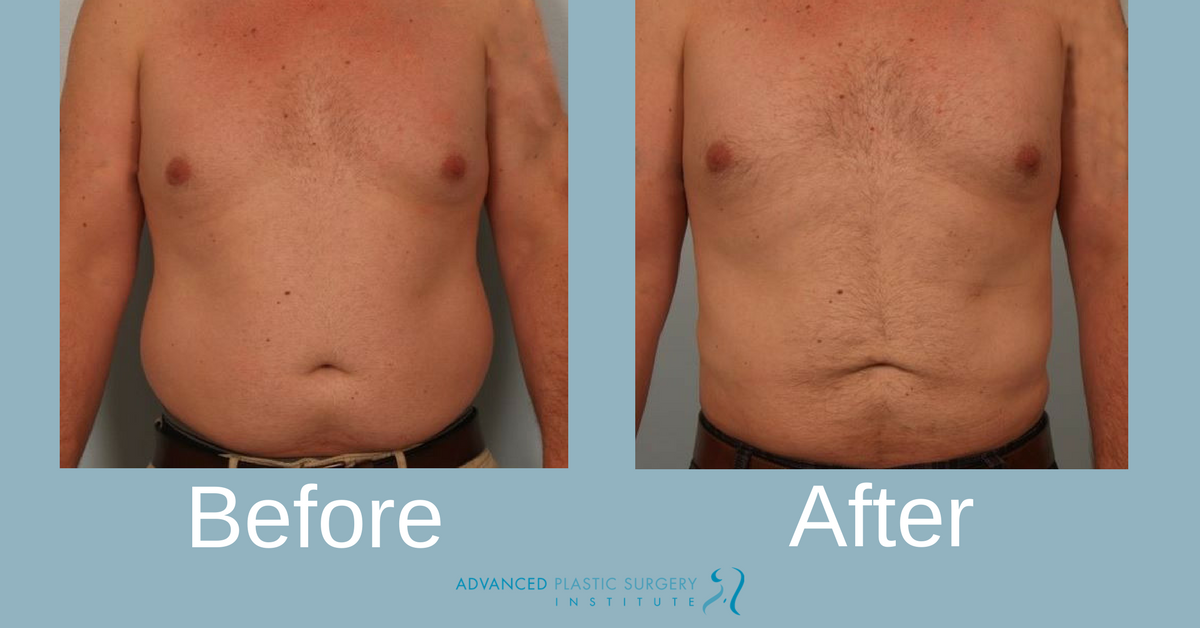 Real Liposuction Male Patient Before and After Treatment