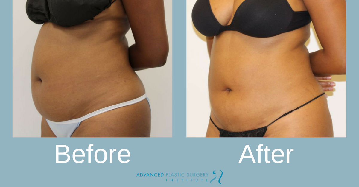 Real Liposuction Patient Before and After Treatment
