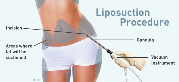 Liposuction procedure