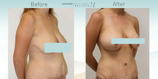 This breast augmentation patient near Gilbert, AZ, wanted a boost after baby."