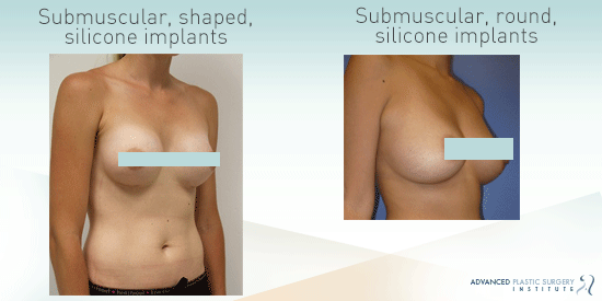 See before-and-after images from breast augmentation patients in Chandler, AZ.