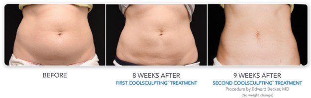 CoolSculpting Before & After