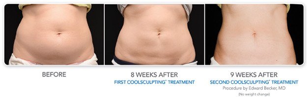 CoolSculpting Before & After