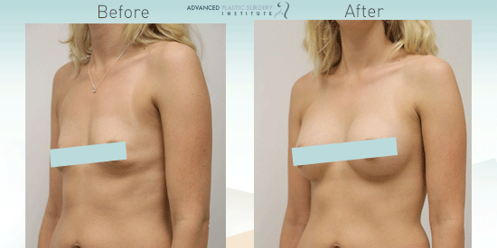 See breast augmentation results from patients in Chandler, AZ.