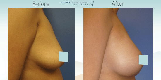 Breast augmentation images from Chandler, AZ, plastic surgeon, Dr. Josh Olson.
