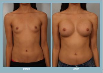 Breast augmentation before-and-after photos