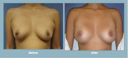 Breast augmentation before-and-after photos