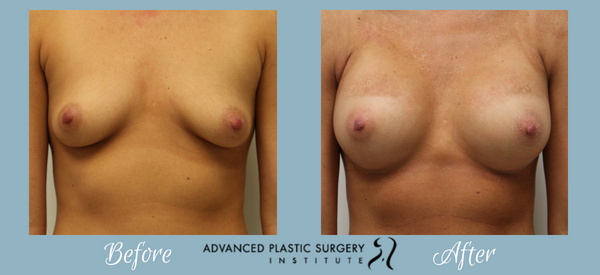Breast augmentation before and after by Dr. Josh Olson