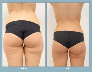 Liposuction before-and-after photos