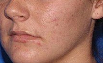Microneedling after image