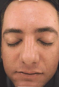 Microneedling after image