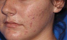 Microneedling before image