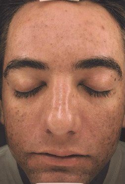 Microneedling before image