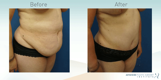 See more before-and-after pictures of tummy tuck patients in Chandler, AZ. 