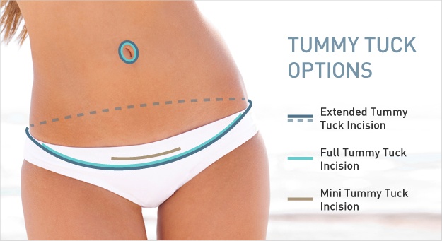 Tummy Tuck insicion locations