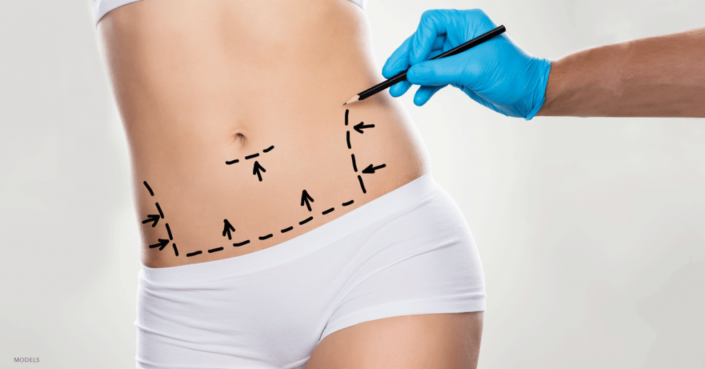 Woman's stomach with gloved hand marking incision lines with dashes and arrows