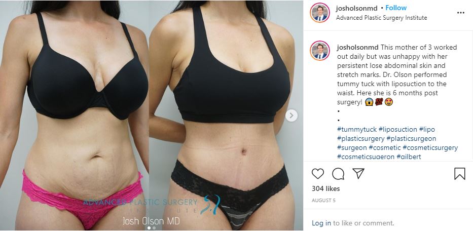 Josh Olson MD - Before and After - Tummy Tuck