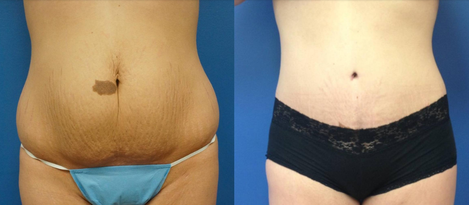 tummy tuck before and after photos