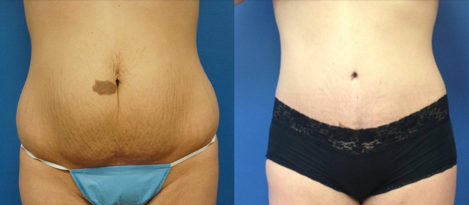 How To Spot Best Tummy Tuck Results in Before and After Photos