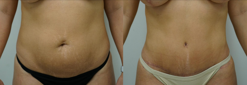 tummy tuck scar