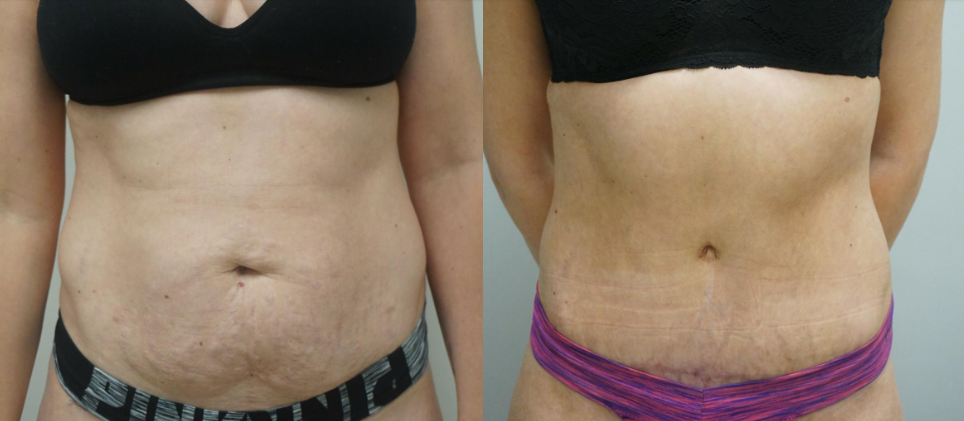 tummy tuck bellybutton