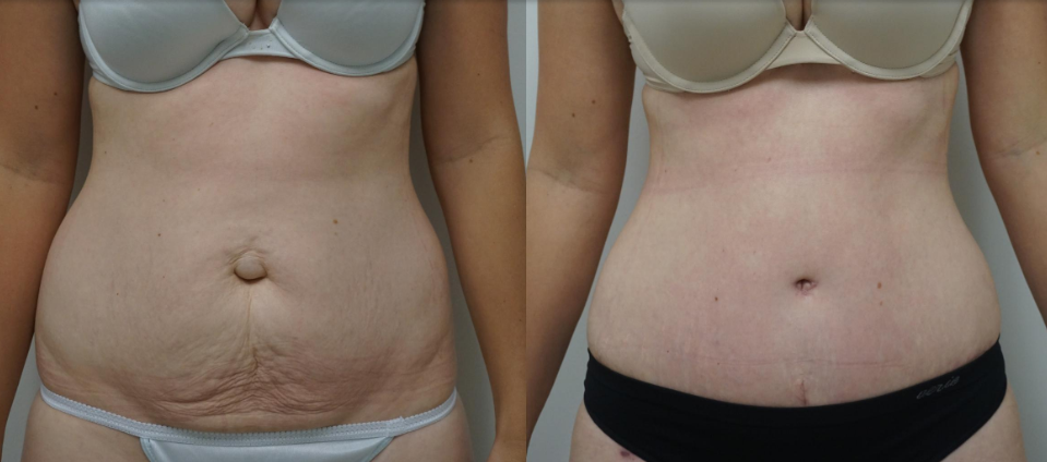 tummy tuck before and after photos