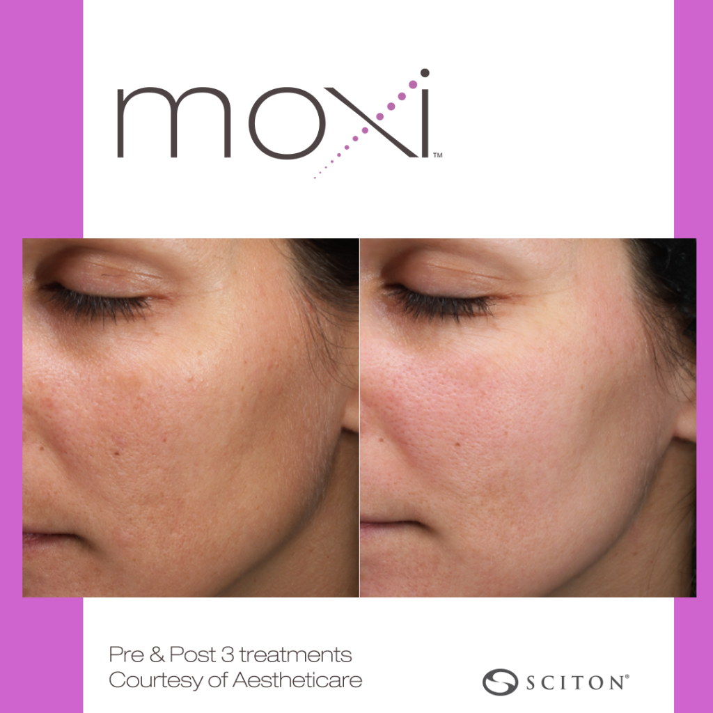 woman's face before and after 3 moxi laser treatments