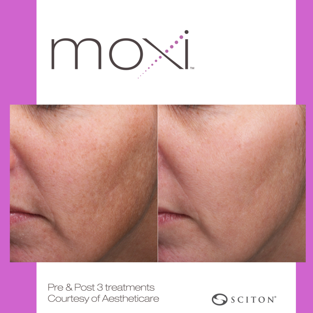 woman's face before and after 3 moxi laser treatments