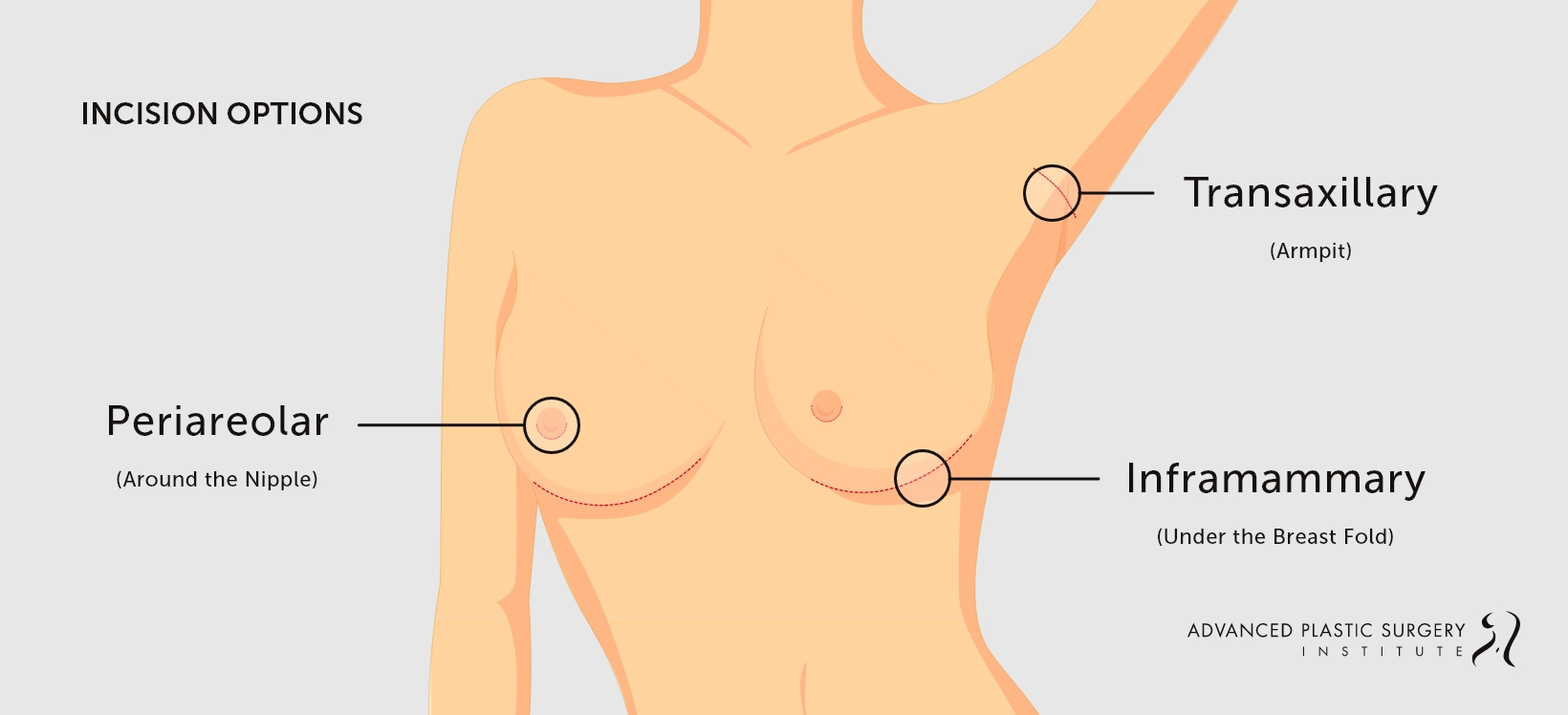 Illustration of breast augmentation incision options