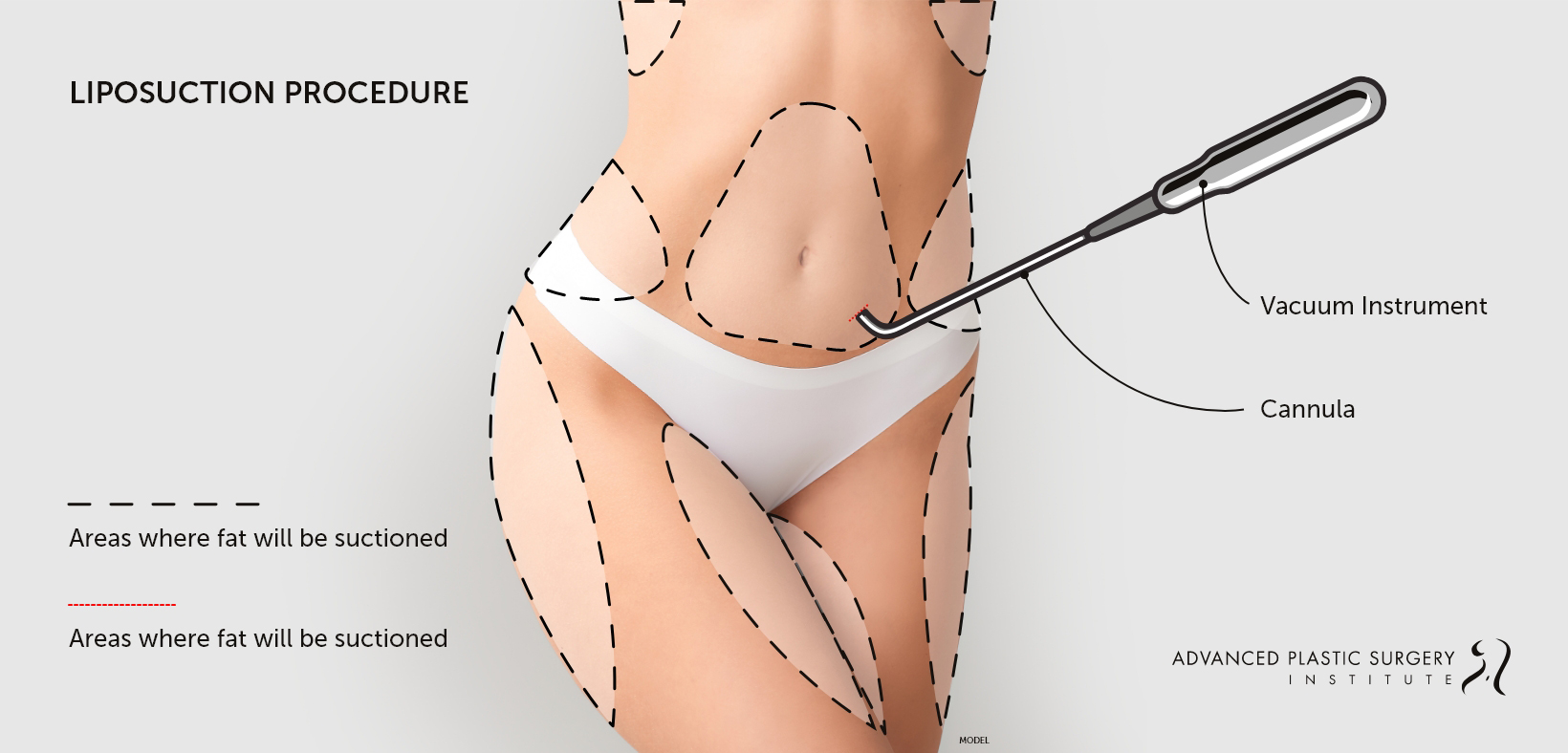 Infographic detailing the liposuction procedure