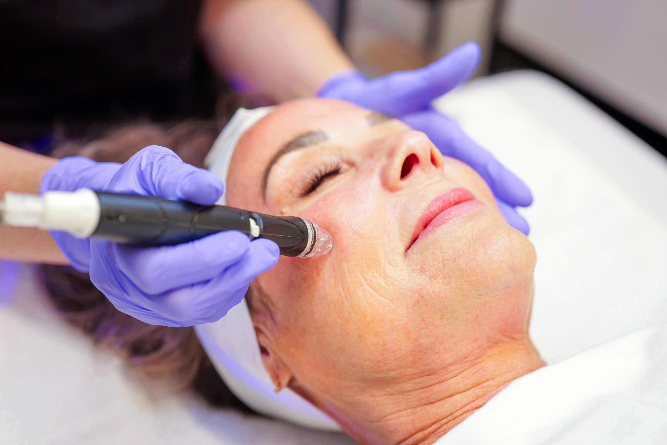 Woman with eyes closed, being treated with a microneedling pen