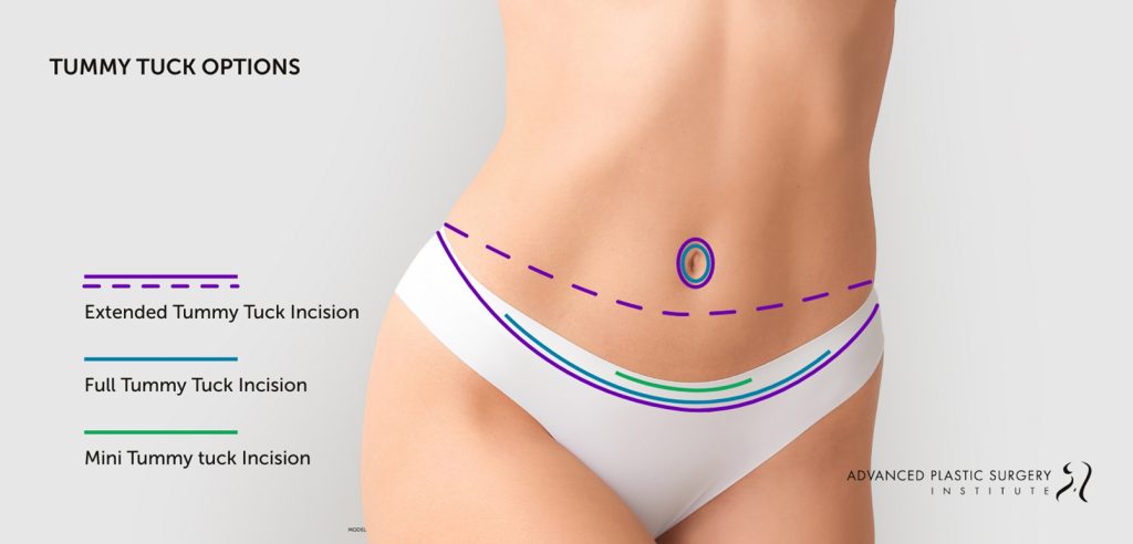 Infographic displaying tummy tuck incision locations