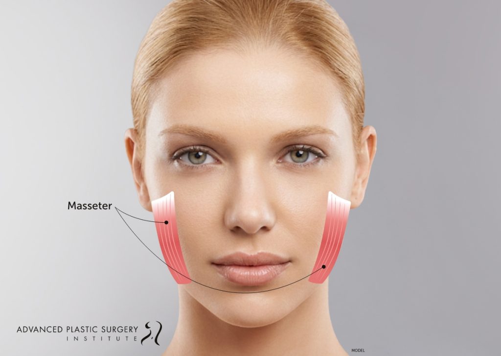 A diagram of a woman’s face, showing the location and structure of the masseter muscles.