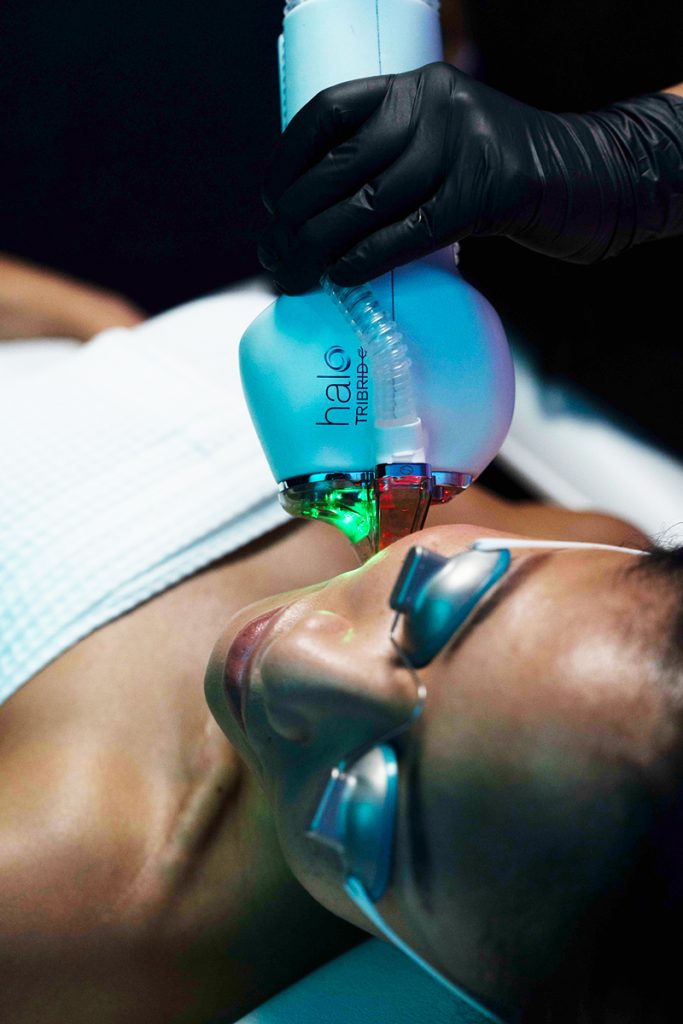 Provider using the HALO TRIBRID laser skin resurfacing device to treat a patient's face, with the patient's eyes protected by eyewear.